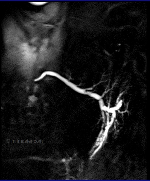 mri parotid sialography sagittal haste image | mrimaster.ru